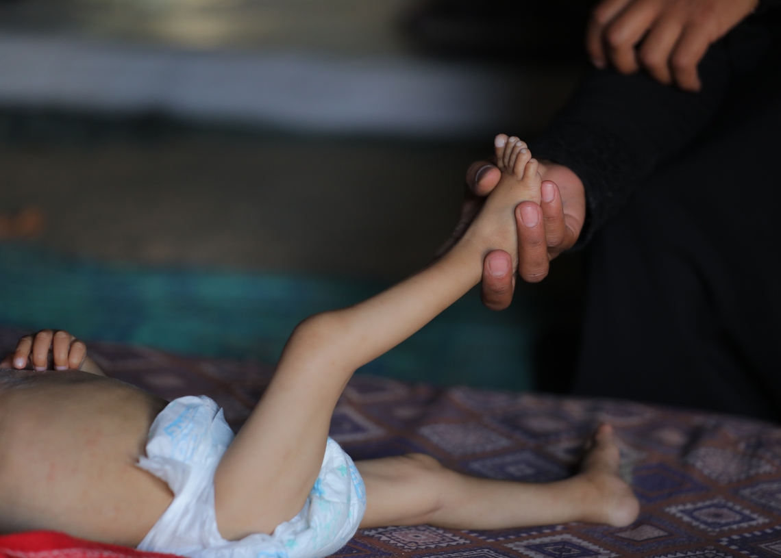 פעוט פלסטיני שסובל ממחסור במזון במרכז רצועת עזה | צילום: פלאש 90