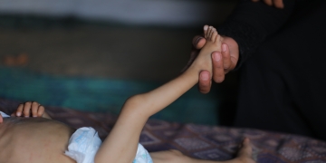 פעוט פלסטיני שסובל ממחסור במזון במרכז רצועת עזה | צילום: פלאש 90